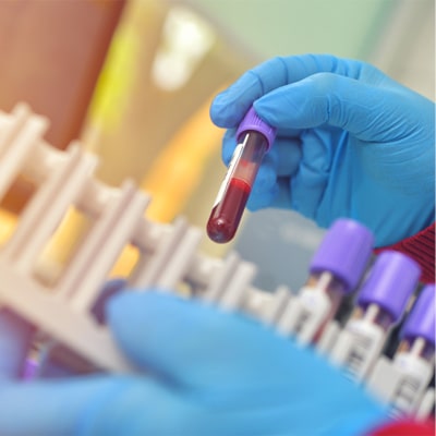 Promisecare Medical Group - A person holding a blood test tube in a hematology laboratory.