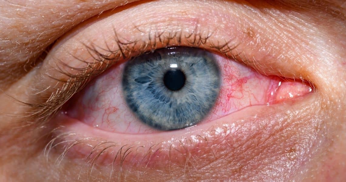 Promisecare Medical Group - Close-up of a human eye with a blue iris and visible blood vessels.